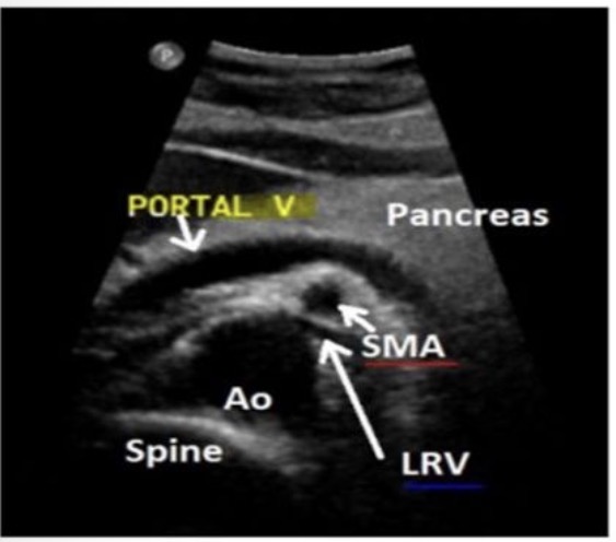 <p>SMA is sandwiched between the aorta and splenic vein</p>