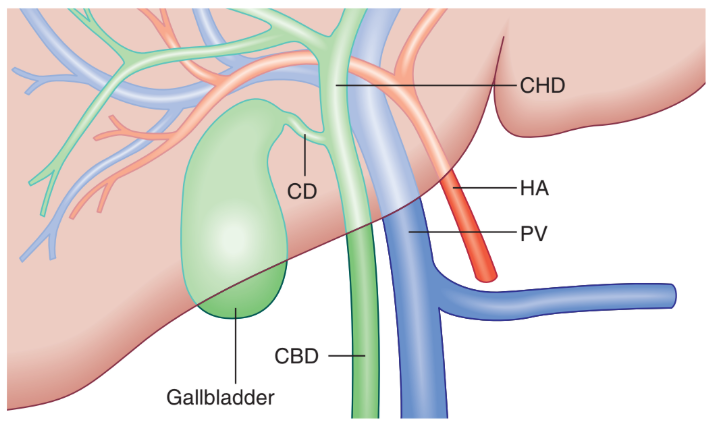 <p>Normal Common Bile Duct, Portal Vein, and Hepatic Artery: Illustration and Sagittal view.</p><p>(A) The illustration demonstrates the normal relationships of some of the structures in the porta hepatis.</p>