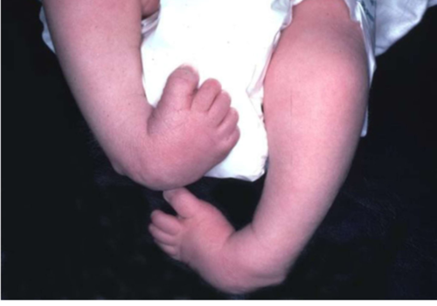 <p>most common type of clubfoot. soles of feet turned medially and feet are sharply planter flexed. feet are fixed in tiptoe position</p>