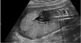 <p>Where is the placenta located?</p>