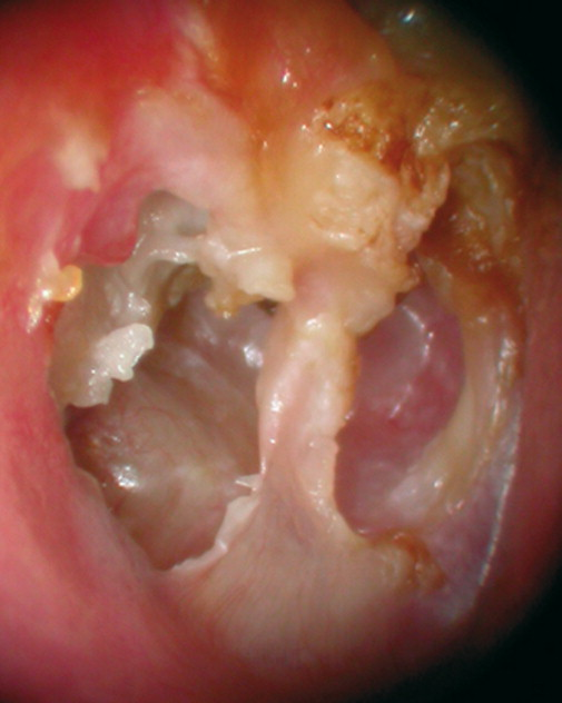 <ul><li><p>Perforació crònica, otorrea de molt mala olor, sense dolor. </p></li><li><p>Tractament: Quirúrgic (<strong>Timpanoplàstia</strong>).</p></li></ul><p></p>