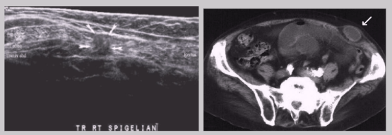 <ul><li><p><span style="background-color: transparent;">Rare</span></p></li><li><p><span style="background-color: transparent;">Almost all occur at the inferior end of semicircular line, inferior to arcuate line where posterior sheath is absent&nbsp;</span></p><ul><li><p>~ About 2 cm from the inguinal crease</p></li></ul></li><li><p><span style="background-color: transparent;">High frequency of incarceration</span></p></li><li><p><span style="background-color: transparent;">Hard to diagnose because it occurs between the muscle or fascial layers of the wall rather than protruding through the wall</span></p></li></ul><p></p>