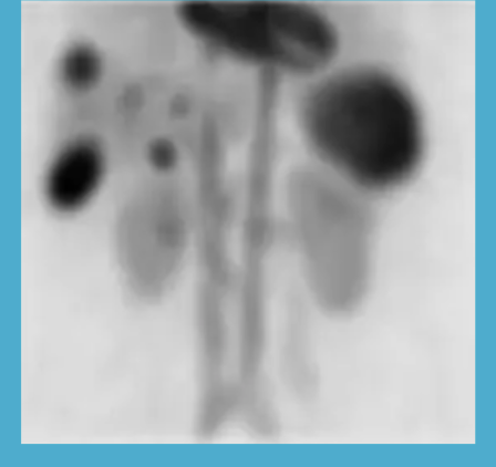 <p>heterogenous uptake of liver parenchyma with the hepatic vessels prominent in various slices </p>