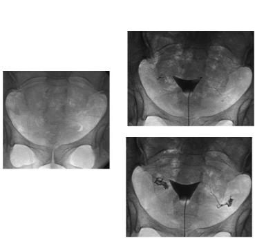 <p>Hysterosalpingogram Prep</p>