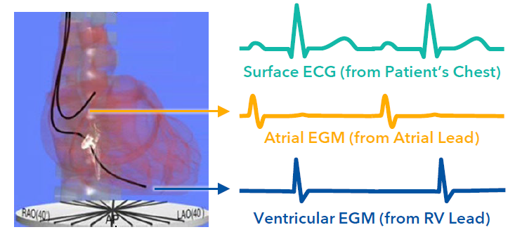<p>intracardiac electrograms (EGMs) </p>