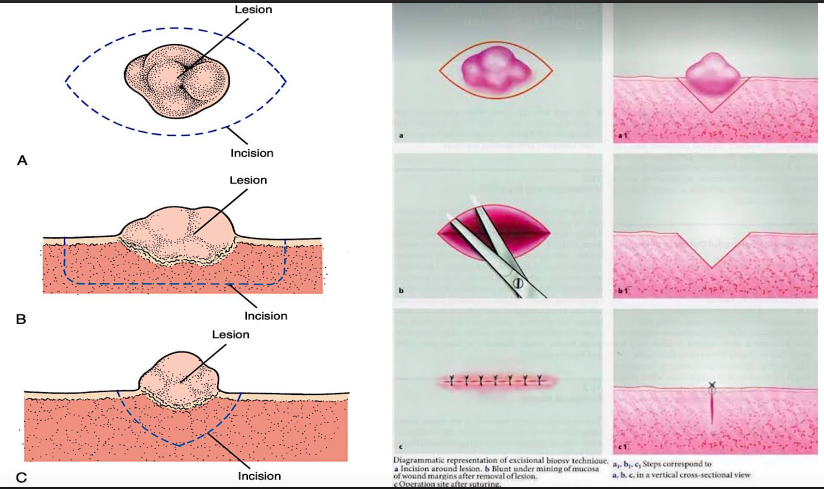 <p>removal of the entire lesion along with <span style="color: red;">2-3mm of normal </span>appearing <span style="color: red;">surrounding tissue</span> is excised</p><ul><li><p><strong>indications:</strong></p><ul><li><p><span style="color: red;">smaller lesions</span> that on clinical examination appear to be<span style="color: red;"> benign</span> (<1 cm)</p></li><li><p>any lesion that can be<span style="color: red;"> removed completely without mutilating</span> the patient</p></li></ul><p></p></li></ul><p></p>