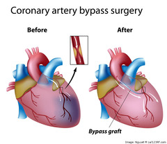 <p>coronary artery bypass graft</p>