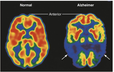 <ul><li><p>Caused by misfolding of proteins that then clump together</p></li><li><p>Plaques of beta-amyloid peptides form in brain</p></li><li><p>Neurofibrillary tangles inside neurons interfere with transport mechanisms  eventually killing neurons</p></li><li><p>As brain cells die, functions are lost, and brain shrinks</p></li></ul><p></p>