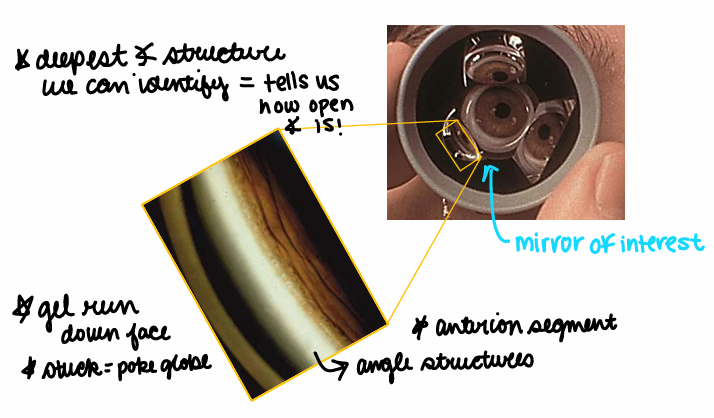 <p>Gonioscopy! 3-mirror or 4-mirror that suction cup to the eye so we’re able to look at the 4 quadrants! This is uncomfortable &amp; we must numb the pt beforehand!</p><p>The 3 mirror gonioscopy lens must be rotated but the 4 mirrors does not need to be. This is also done behind the slit lamp. Gel might run down the pt’s face &amp; if it gets stuck poke the globe!</p><p>The deepest angle structure we can identify tells us how open the angle is.</p>