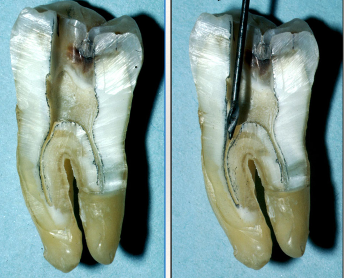 <p>What is the benefit of using Gates Glidden, Hedstrom, or Orifice Openers for coronal shaping?</p>