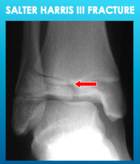 <p>Salter Harris III Fracture</p>