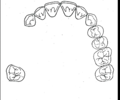 <p>What kennedy classification?</p>