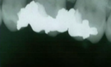 <p>Apices Cut off</p>