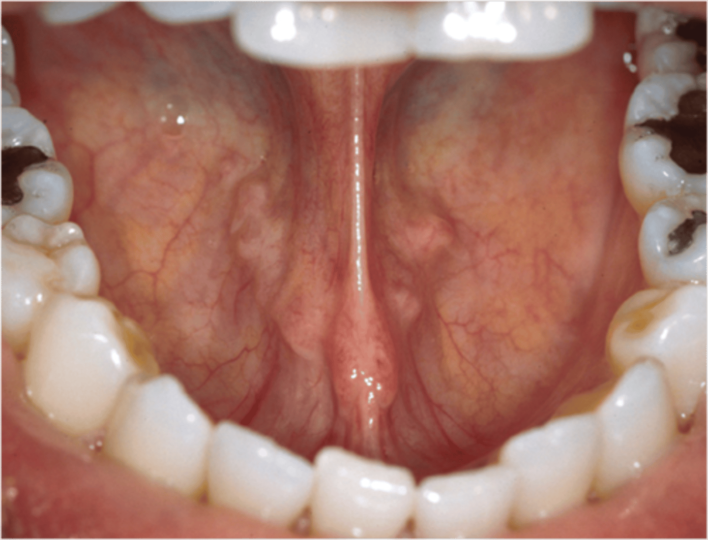 <p>Contains the: lingual, frenum, lingual veins, salivary glands</p>