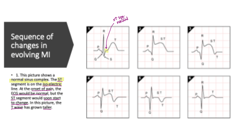 <p><strong>ST-segment elevation</strong></p>