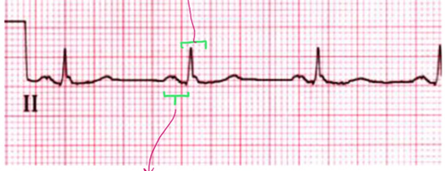 <p>what is the PR interval of this</p>