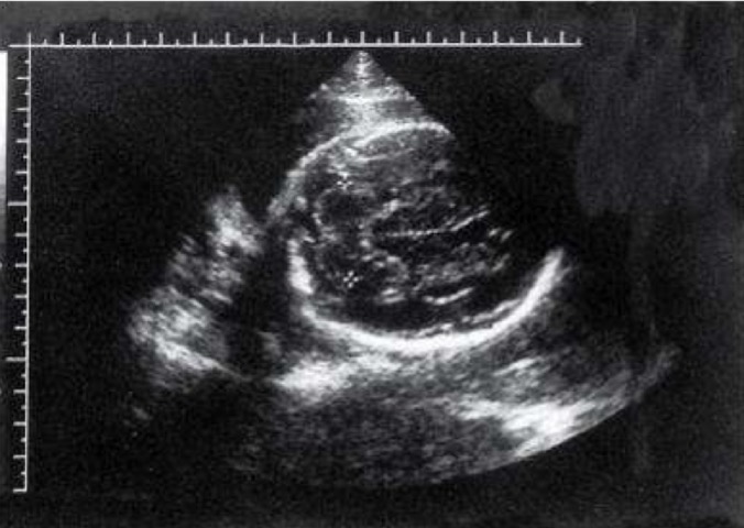 <p>Composed of 2 lateral hemispheres and small central lobe, the vermis; on ultrasound, cerebellar vermis often appears as bright, reflective live dividing homogeneous, low-gray cerebellum</p>