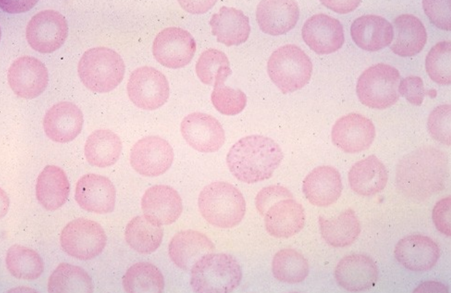 <p>what would the what would the RBC morphology look like in those with heterozygous beta-thalassemia? <strong>(learning objective)</strong></p>