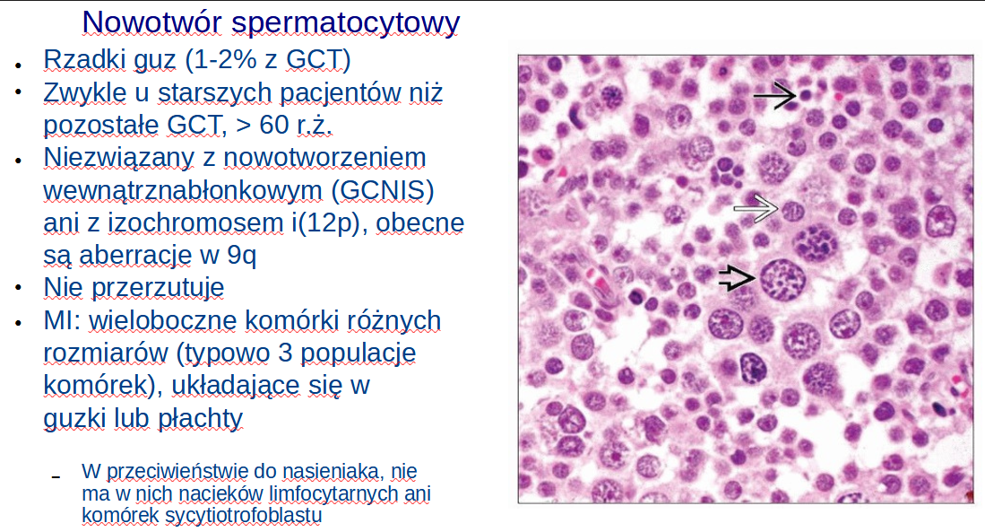 <p>D. guz spermatocytowy</p><p></p><p>Pamiętajcie, że najczęstszym złośliwym nowotworem jądra u pacjentów po 60 roku życia jest chłoniak.</p>