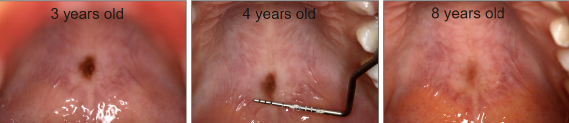 <p>treatment for melanocytic nevus</p>