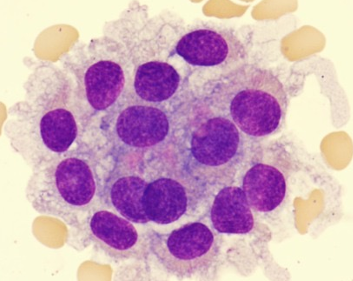 <p><strong><u>Predominant Cells in CSF</u></strong></p><ul><li><p>for <span style="color: yellow;">diagnostic procedures</span></p></li><li><p>seen in clusters with distinct nuclei & distinct cell walls</p></li></ul><p></p>