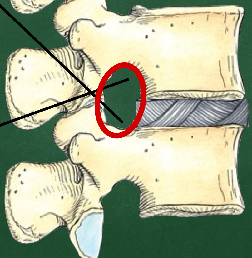<p>Through what opening do spinal nerves exit?</p>