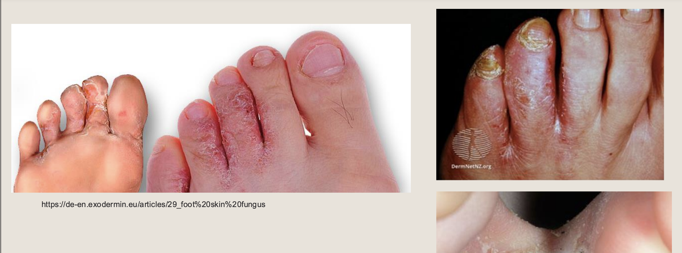 <p>what is this and what is it caused by</p>