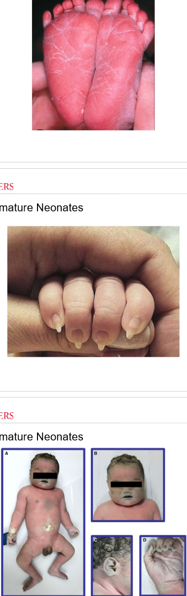 <ul><li><p>dry, peeling, cracked skin </p></li><li><p>lack of vernix </p></li><li><p>profuse hair </p></li><li><p>long fingernails </p></li><li><p>thin, wasted appearance</p></li><li><p>meconium staining (green or yellow staining on skin, nail beds, or umbilical cord)</p></li><li><p>hypoglycemia </p></li><li><p>poor feeding behavior</p></li></ul><p></p>