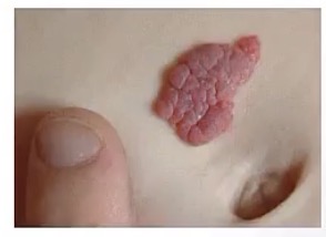 <p>-proliferation of blood vessels</p><p>-newborns; no, usually within first few days/months after birth</p><p>-single lesion</p><p>-they involute within a few years</p>