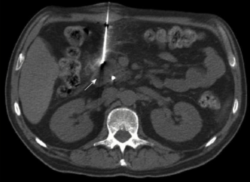 <p>procedure where needle is inserted into suspected lesion/organ to obtain cells/tissues for analysis/diagnosis</p><ul><li><p>for suspected primary/metastatic malignancy</p></li></ul><p></p>