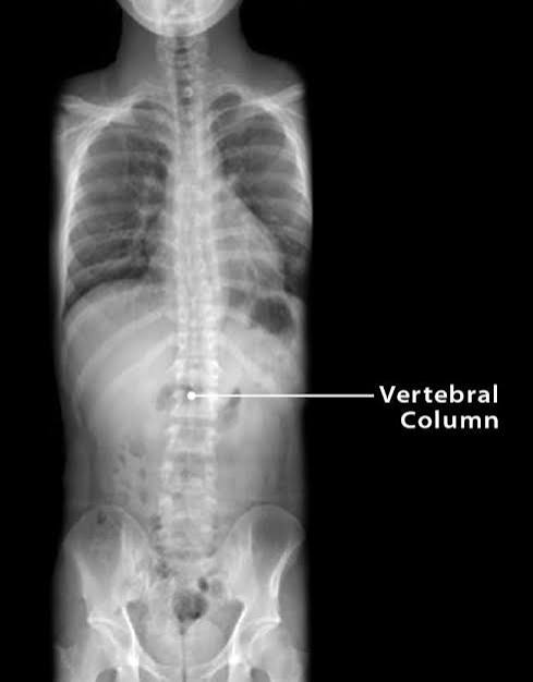 <p>Vertebral Body</p>