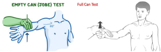<p><strong>tear of the supraspinatus (rotator cuff)</strong></p><p>have patent standing- stand behind them</p><p><strong>full can: </strong>bring both arms up to sides (flying) wiht thumbs facing celling push down on wrists</p><p><strong>empty can: </strong>flip arms so thumbs facing ground then push on wrists again</p><p>positive if: decreasre in stregth or increase in pain <strong>in thumbs down position compared to the thumbs up position (more pain in thumbs down)</strong></p>