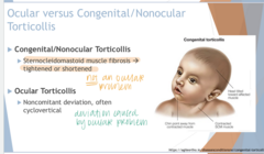 <p>What is Ocular Torticollis due to?</p>