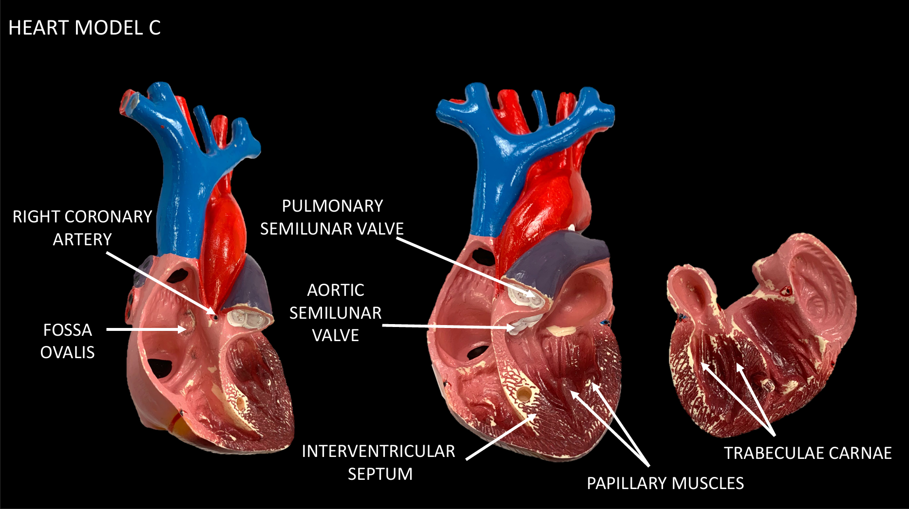 <p>RIGHT CORONARY ARTERY</p>