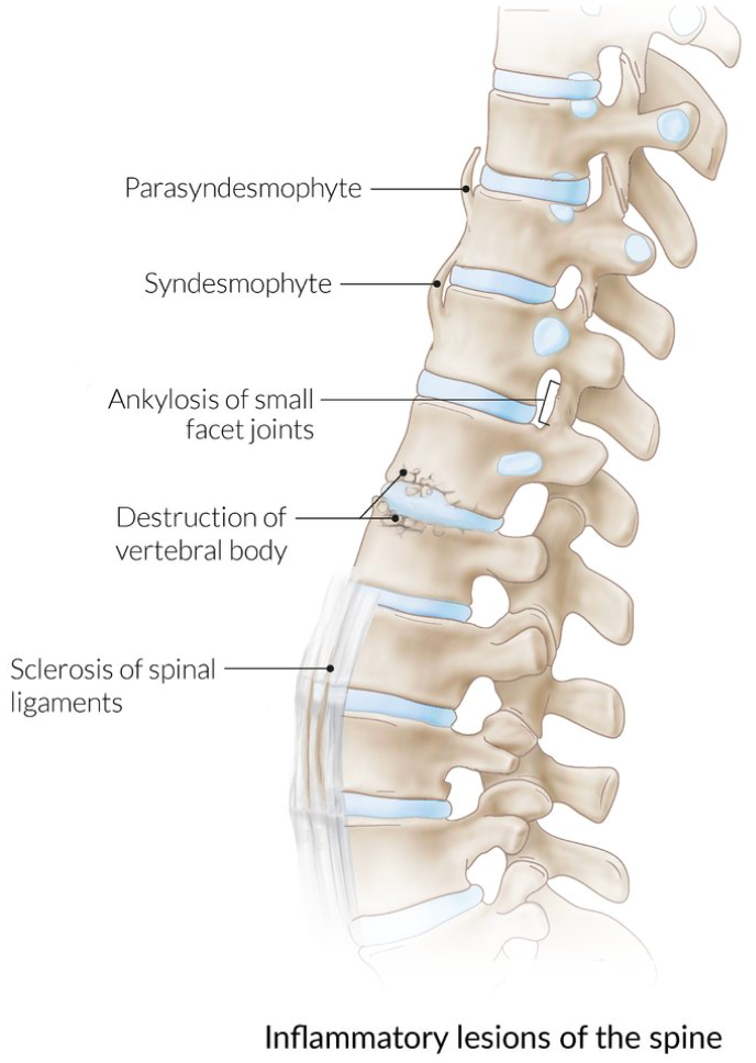 <ol><li><p>Sacroiliac joint erosion</p></li><li><p>Vertical syndesmophytes (bony growths) on spinal ligament or annulus fibrosus</p></li><li><p>Syndesmophyte fusion = Ankylosis of intervertebral discs + vertebral bodies</p></li></ol><p></p>