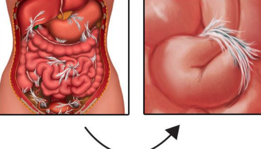 <p>Fibrous band of tissue interrelates with the intestine, creating a blockage</p><ul><li><p>Most common cause of mechanically based obstruction</p></li><li><p>Distended loops of air-filled small intestine</p></li></ul><p></p>