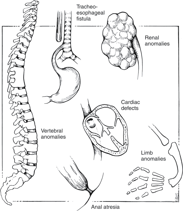 <p> vertebral anomalies, anal atresia, cardiac anomalies, tracheoesophageal fistula or esophageal atresia, renal anomalies, and limb anomalies;  Patients are considered to have this association if three of the organ systems listed have abnormalities</p>