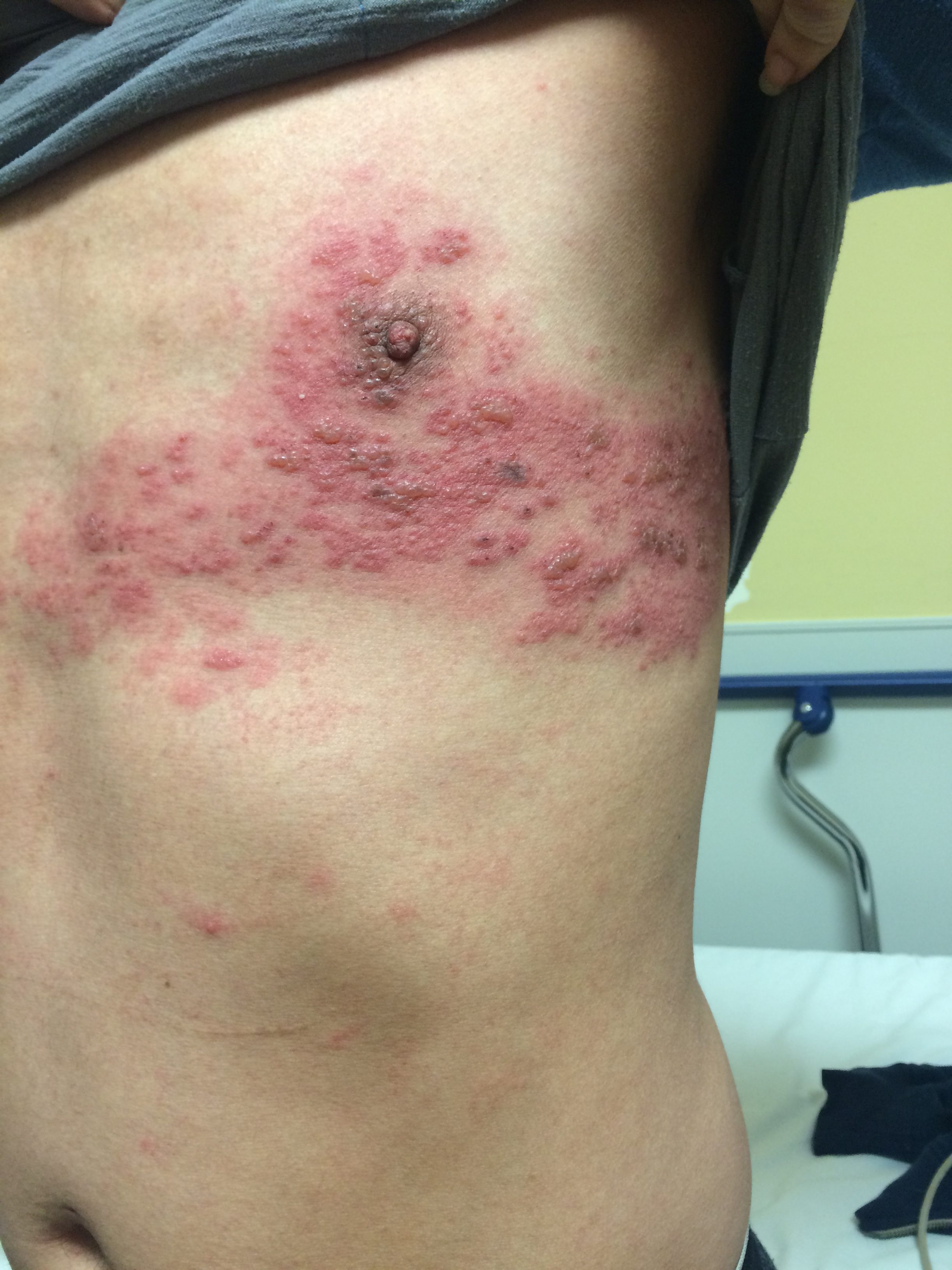<p>Reactivation of the varicella-zoster virus (the virus that causes chickenpox) in the body. </p>