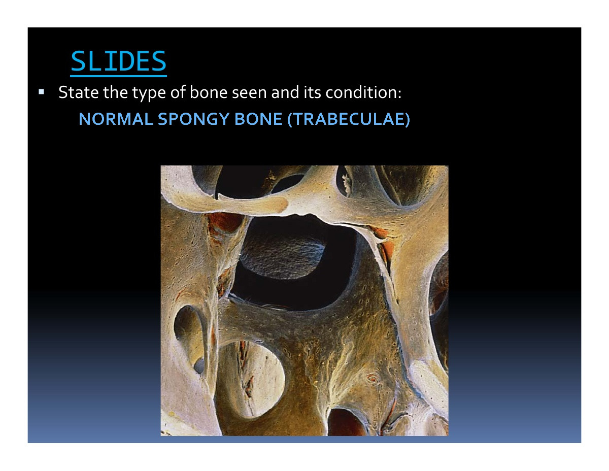 Normal Spongy Bone (Trabeculae)