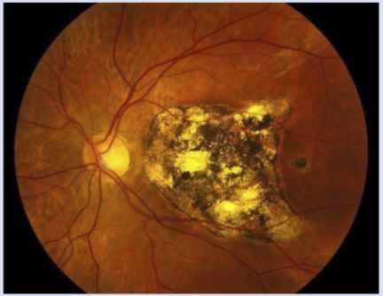 <ul><li><p>Endstage wet AMD, when retinal tissue is replaced w/ scarring and fibrosis</p></li><li><p>CNVM can still bleed/leak</p></li></ul><p></p>