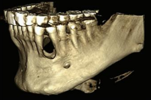 <p>A 43-year-old male patient with a complaint of painless swelling in the left mandibular premolar region. Although the history revealed a presence of the swelling for more than one year without any associated symptoms, the patient preferred to obtain clinical consultation as he was concerned about the swelling. The patient had no previous history of dental treatment except for periodic oral prophylaxis. Provide two differential diagnosis</p>