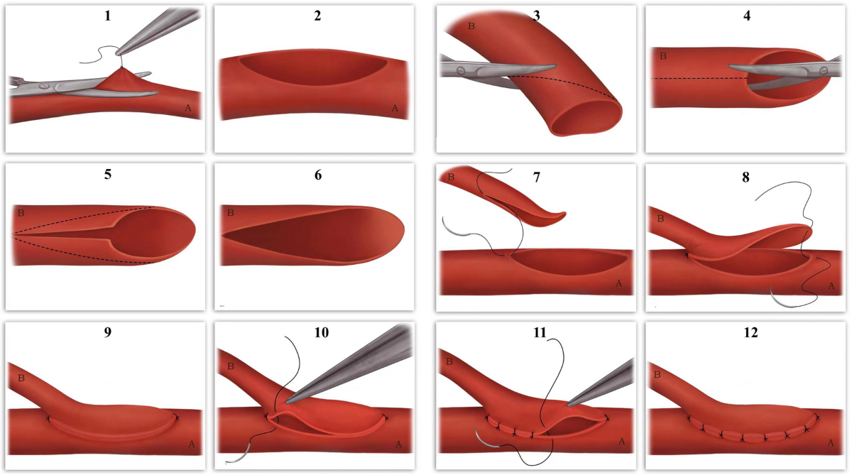 <p>anastomosis: Surgical procedure for connecting two tubes (blood vessles)</p><p>Challengs: Preventing  leakage, infection, aneurysm, fibrosis, narrowing, and clotting</p><ul><li><p>at the time when they started no antigoagulatns were avaliable </p><ul><li><p>what methods are used: finer silk and finer needles </p></li><li><p></p></li></ul></li></ul><p></p>