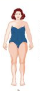 <p>What is a Pear shaped body for obesity called?</p>