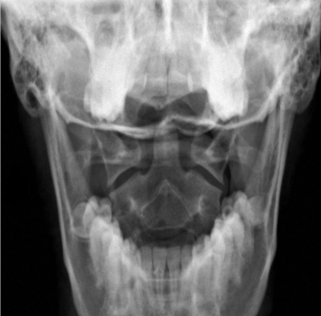 <p>Anterior-Posterior Open Mouth Landmarks</p>