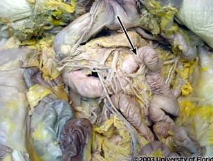 <p>what is the term used to descibe where the duodenum becomes the jejunum (as pictured here)?</p>