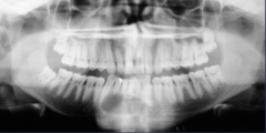<p>Describe the internal architecture of the lesion: (4)</p>