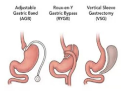 <p>When is bariatric surgery used?</p>