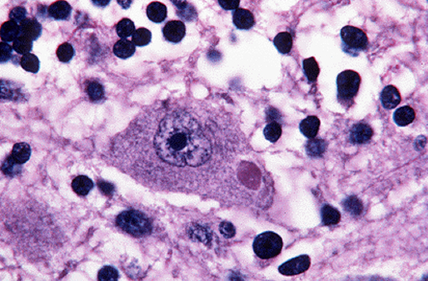 <p><span>the rabies virus is an <strong>RNA virus </strong>that is transmitted to humans in the <u>saliva of a rabid animal</u>. The original site of infection is <u>muscle cells </u>at the site of transmission. The virus eventually enters nearby<strong> nerves and travels to the brain</strong>. </span></p><p><span>Once in the brain, the virus produces characteristic inclusion bodies, called <u>Negri bodies</u></span></p>