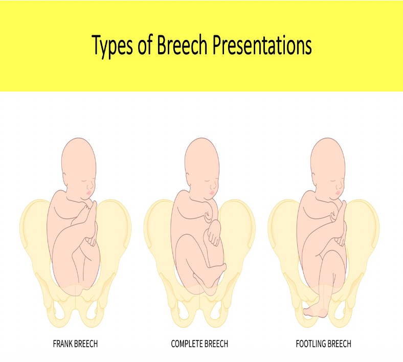 <p>B. Complete</p><p>Frank breech = butt down legs straight up in front of abdomen</p><p class="p1">Complete breech = butt down legs folded, knees bent, ankles crossed</p><p class="p1">Footling breech = feet down, baby "standing" on cervix</p>