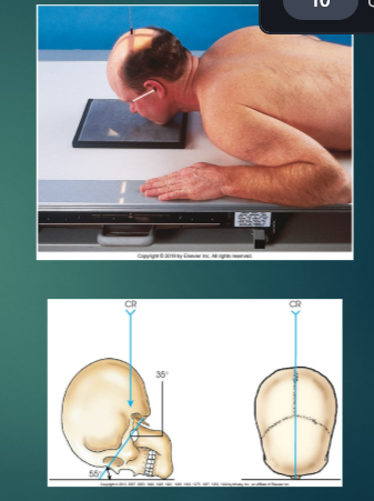 <p>pat pos of MODI PAREITALACANTHIAL (MODI WATER) — <strong>MANDIBLE</strong></p>